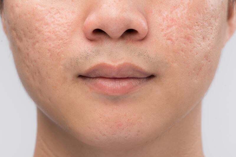 man with acne scarring