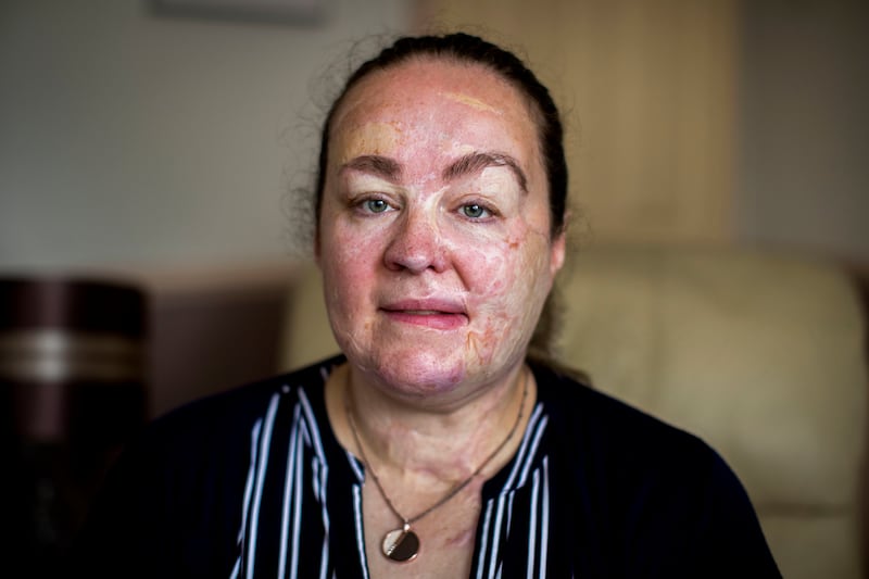 Omagh bombing survivor Donna-Marie McGillion, said she still lives with daily pain