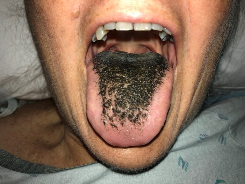 Hairy tongue condition.