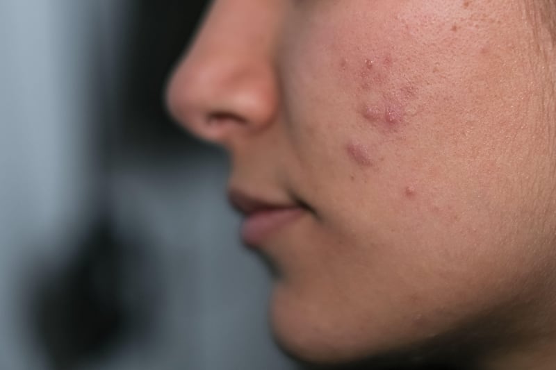 Some women with PCOS have acne, others don’t