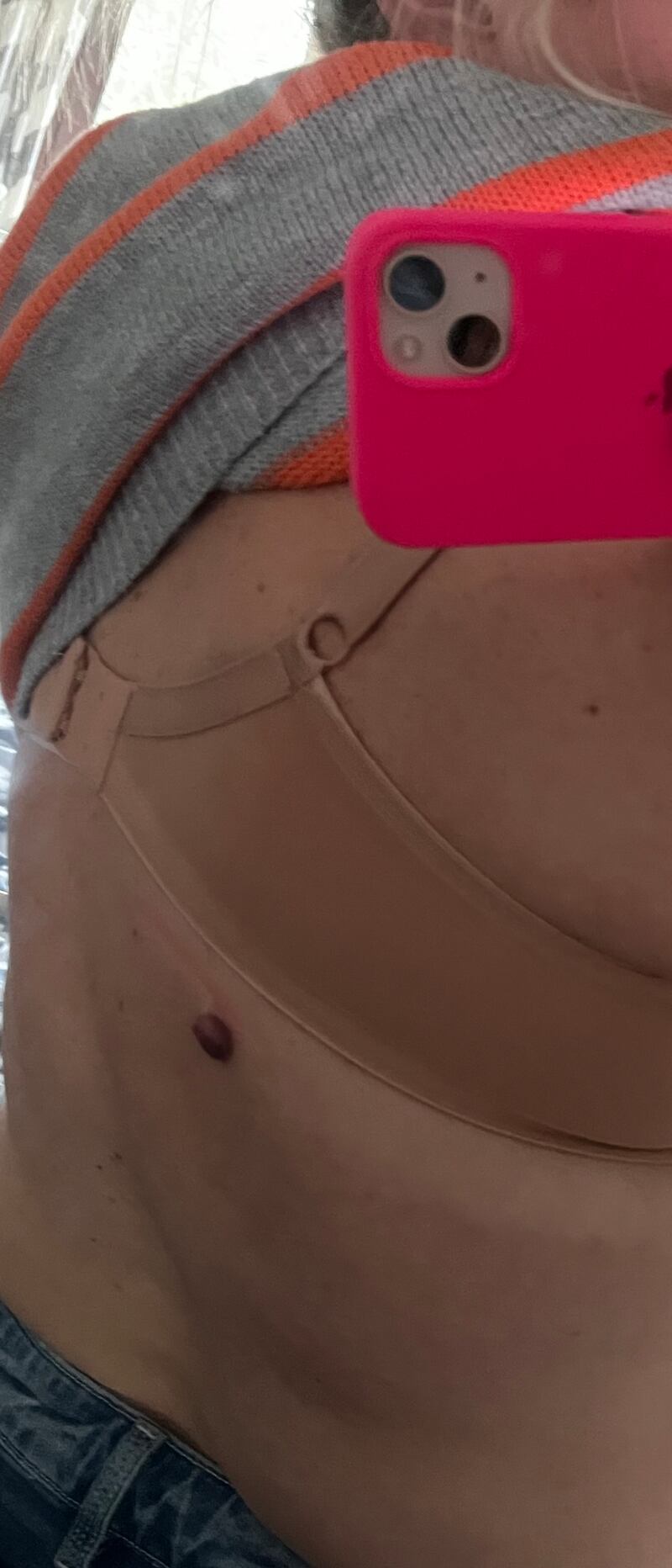 The mole on Natasha Gowan’s lower back before it was removed