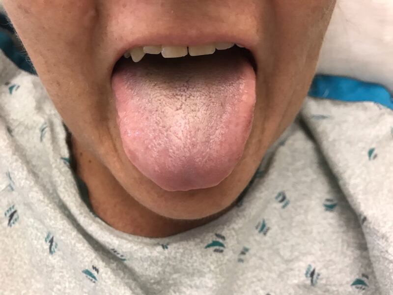 Hairy tongue condition being cured.