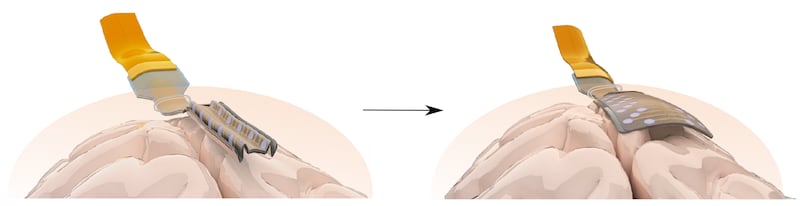 An artist’s impression showing how the electrodes unfold in the brain (Massimo Mariello/University of Oxford)