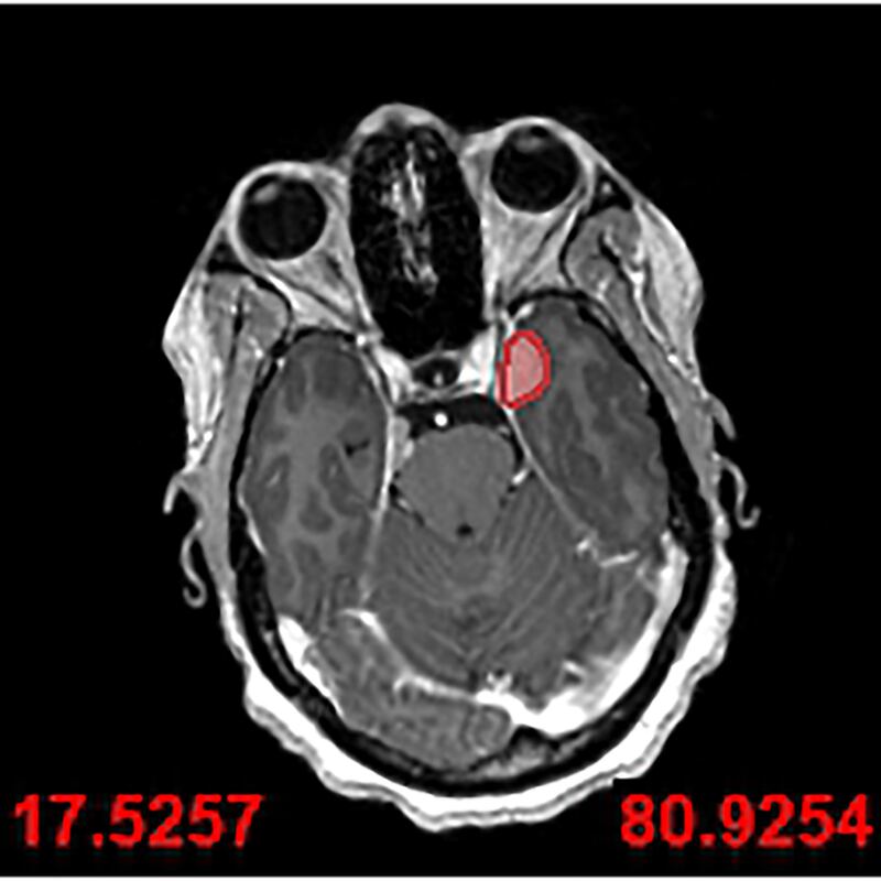 An MRI scan used by surgeons to visualise Ruvimbo Kaviya’s tumour