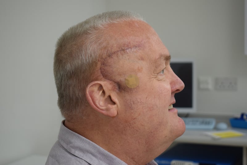 Paul Read after the surgery to remove his brain tumour.