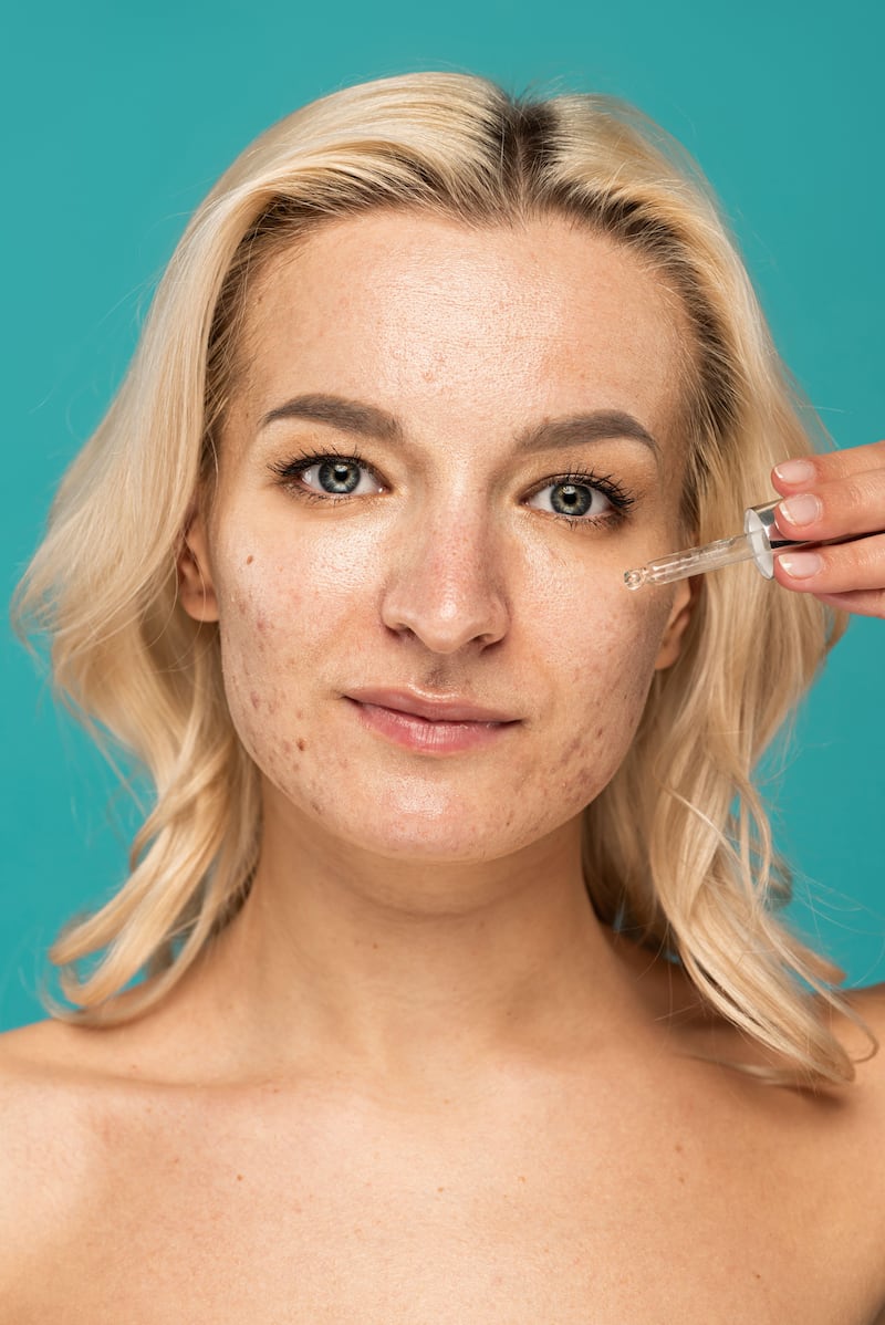 woman with acne scarring applying serum