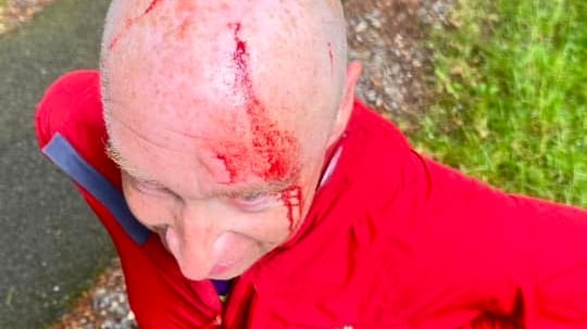 Steven Morgan's injuries after being attacked by a buzzard in the Mournes