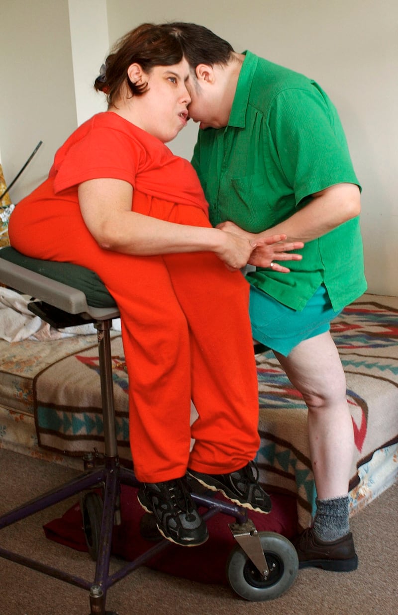 Conjoined twins George and Lori Schappell (Brad C Bower/AP)