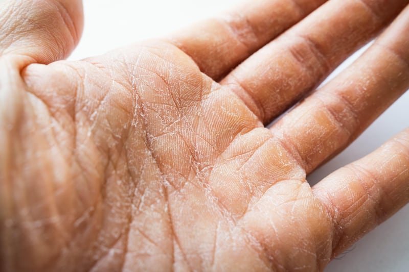 Exposed areas, such as our hands, are most likely to get dry