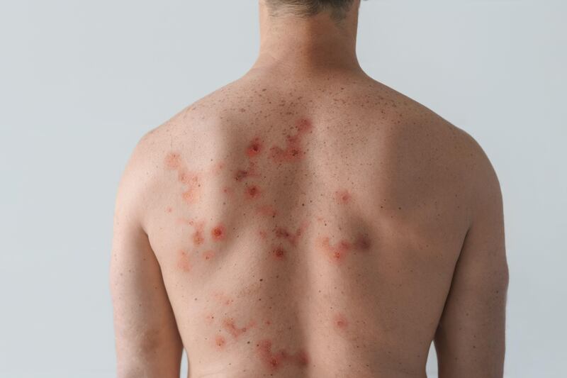 Male back affected by blistering rash caused by mpox