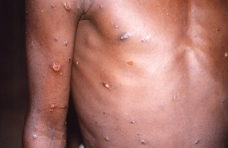 A new strain of mpox has been reported in parts of Africa