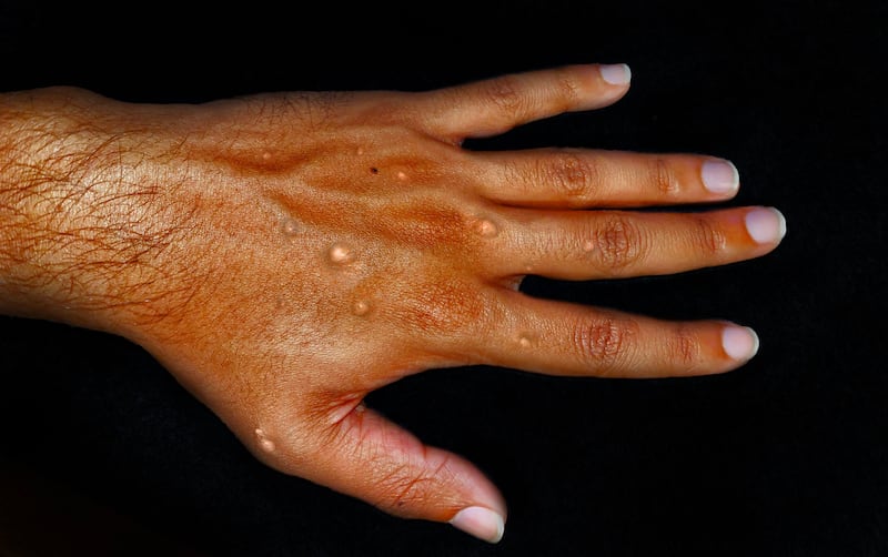 Rash and blisters on a hand from a mpox infection