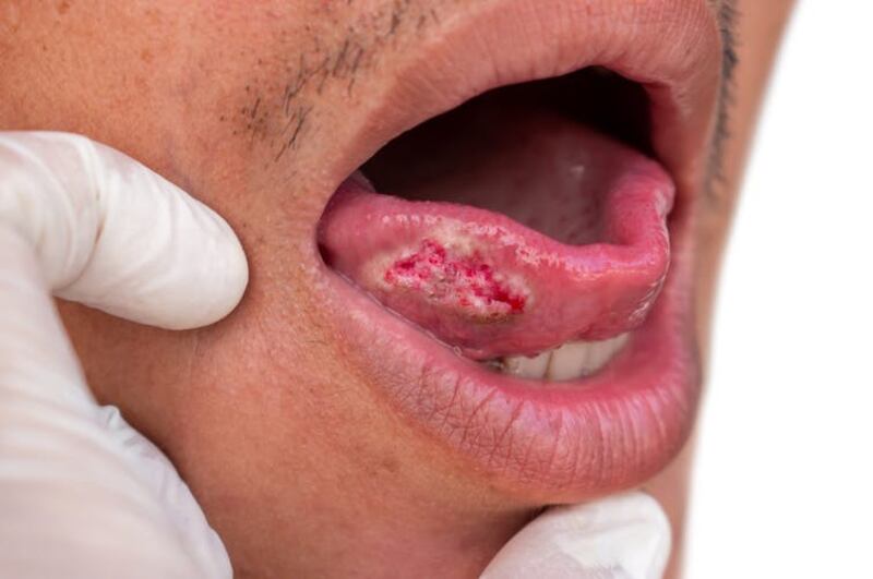 A tongue with squamous cell carcinoma.
