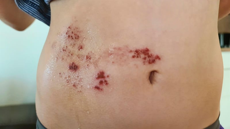 Blisters often appear on your torso if you have shingles