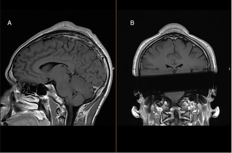 MRI scan images show the mass on the man’s head (BMJ Case Reports)