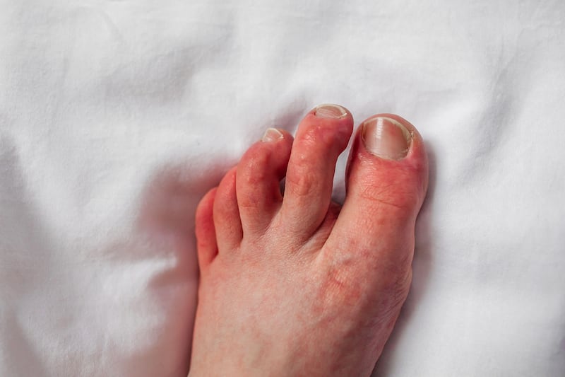 2M04XM0 Chilblains on toes, red itchy bumps, swelling Foot of person with Raynaud’s phenomenon and chilblains lesions Pernio dermatitis on fingers Perniosis