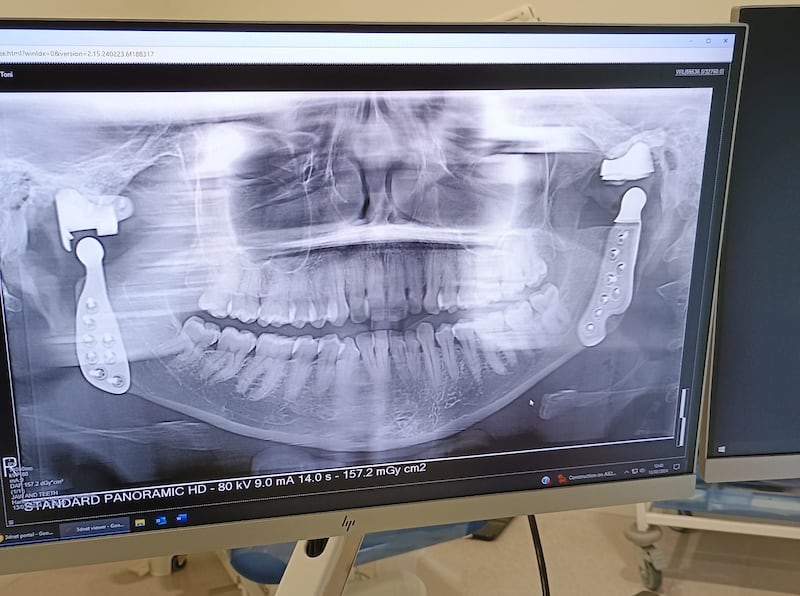 Ms Bull has two titanium jaw joints