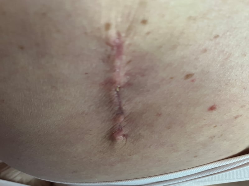 The 10cm scar on Natasha Gowan’s back after her operation