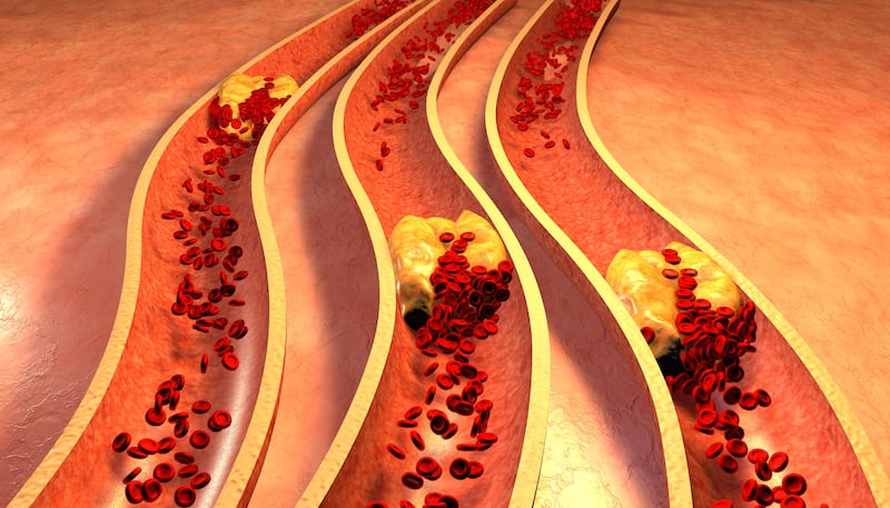 Diagram of a clogged artery with platelets and cholesterol plaque