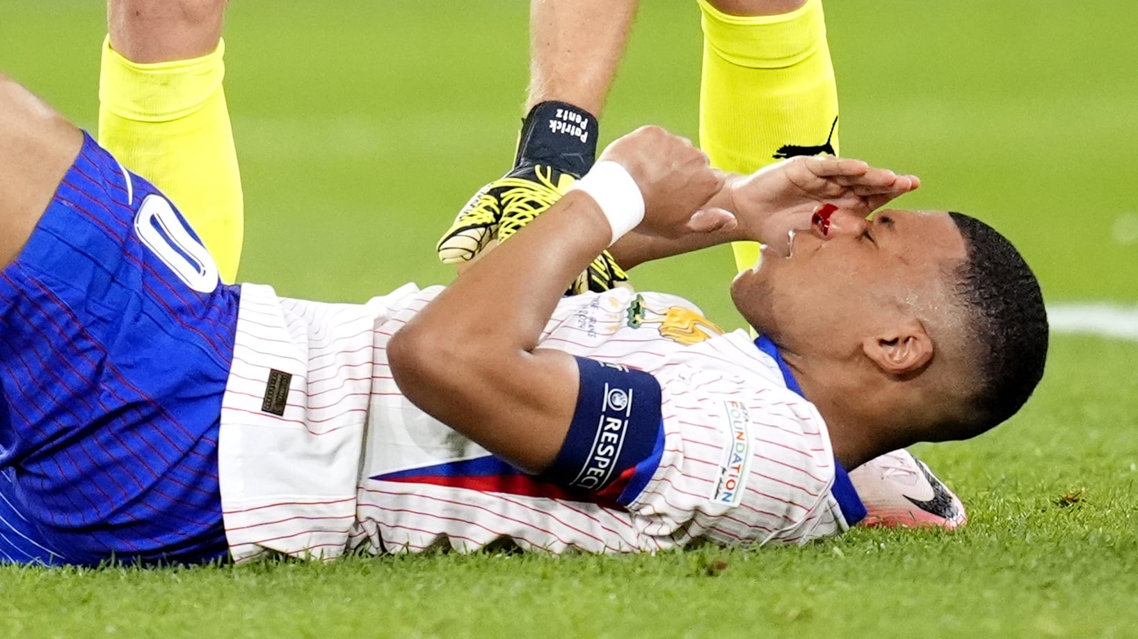 Kylian Mbappe’s broken nose has raised doubts over his continued participation in Euro 2024