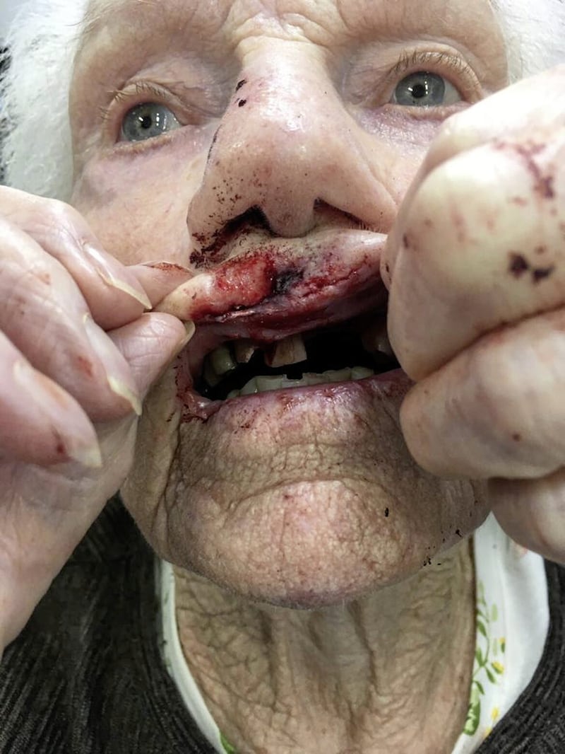 South Belfast&#39;s Alice Rooney (89) lost two teeth and was left with cuts to her face after falling from a pavement in Belfast city centre&#39;s Castle Place. 