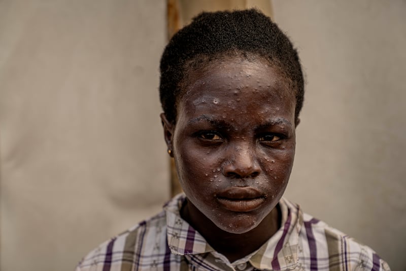 A young girl suffering from mpox waits for treatment at a clinic in Munigi (Moses Sawasawa/AP)