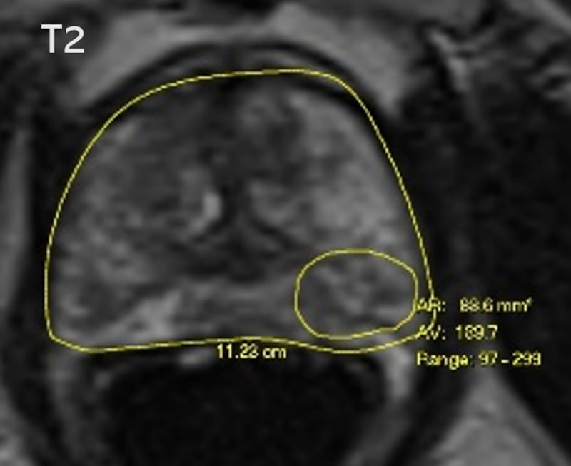 An MRI image showing only one tumour found.