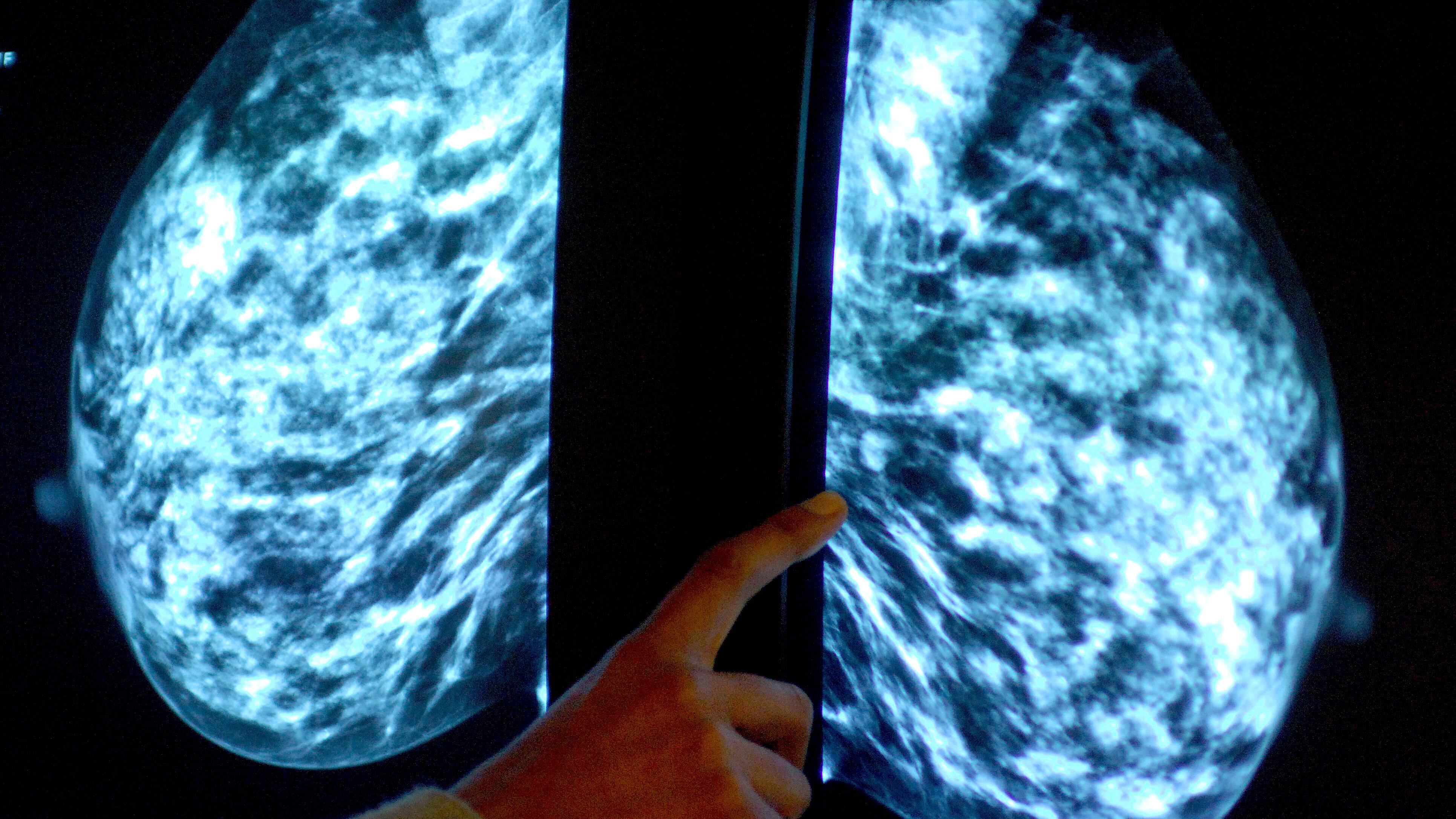 A quarter of a million people have backed a call for a drug to be made available for secondary breast cancer patients in England